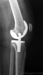 knee1 173x300 Knee Problems of the Superobese