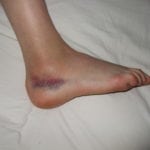ankle_sprain_rick_kaselj1 ankle sprain rick kaselj1 150x150 Why Your Ankle Exercise Rehab Program is Not Helping Your Clients
