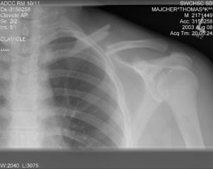 Clavicle fracture left 300x238 What Causes Shoulder Pain?