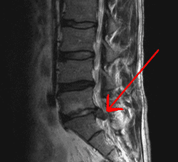 Disc-Herniation Disc Herniation Have We Drunk Too Much of the McGill Cool Aide?