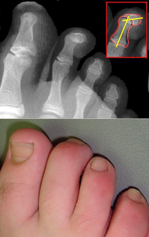 7 Keys to Your Foot Health Hammerzehe 7 Keys to Your Foot Health