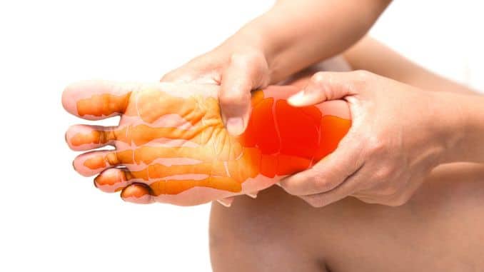 plantar fasciitis