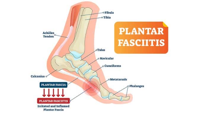 Plantar-Fasciitis