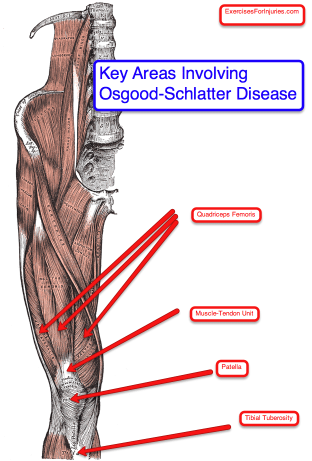 Osgood-Schlatters Disease - Exercises For Injuries