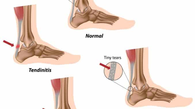 Achilles Tendon Injuiries