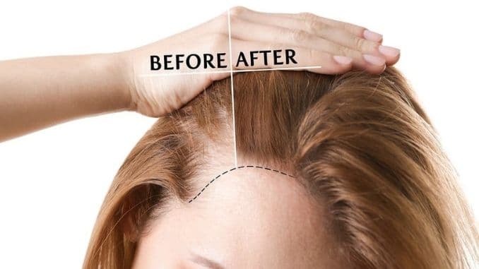 before-and-after-hair-loss - causes of hair loss