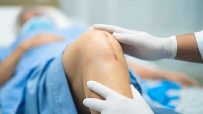 Total Knee Replacement or Arthoplasty- Stages of Osteoarthritis