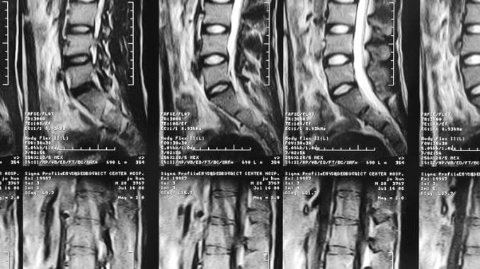How does Coccydynia occur- stretches for tailbone pain