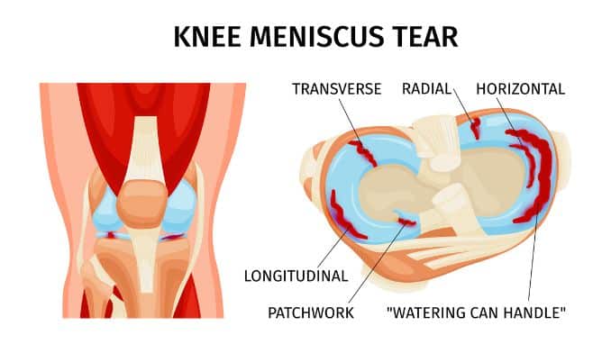 Meniscus Tear Anatomy