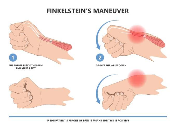 What is The Finkelstein Test?- gamers thumb