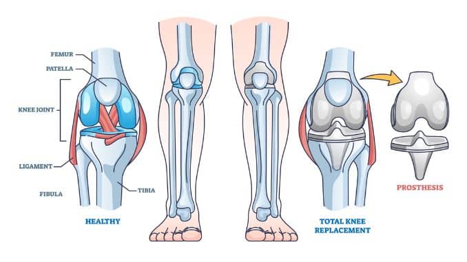 What happens in Knee Replacement Surgery